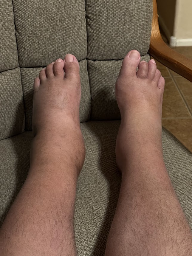 April 2025 Swelling