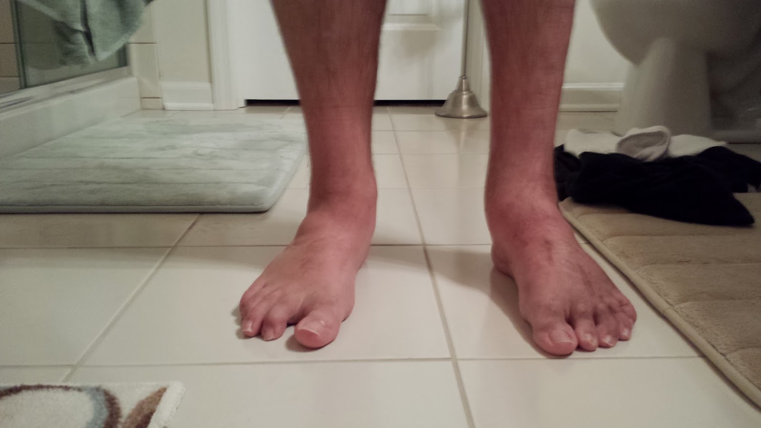 Post-Op Foot