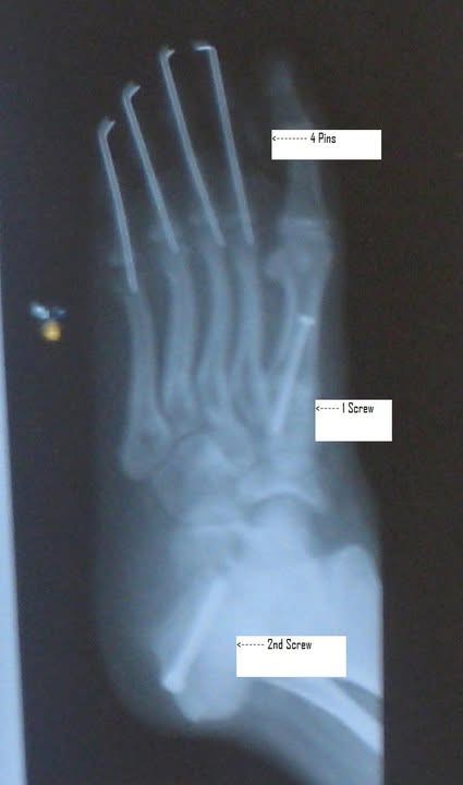 X-ray with pins